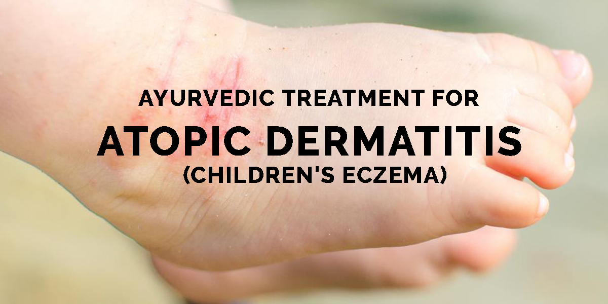 Ayurvedic Treatment For Atopic Dermatitis Dr Brahmanand Nayak