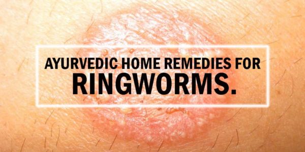 Say Goodbye to Ringworm with Ayurvedic Home Remedies - Dr. Brahmanand Nayak