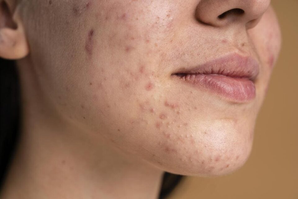 stress and pimples connection