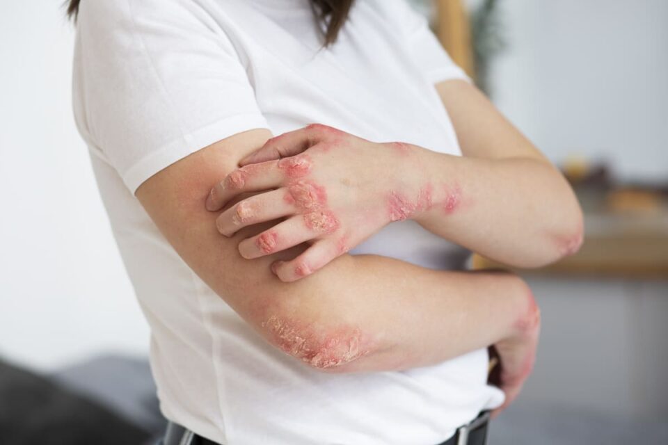 Ayurvedic Psoriasis Treatment in Bangalore